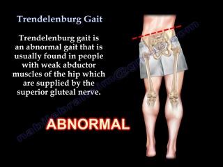 Trendelenburg Gait - Everything You Need To Know - Dr. Nabil Ebraheim