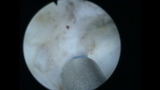 Holmium Laser En Bloc Resection of Bladder Tumor - Ho-ERBT TNT 18